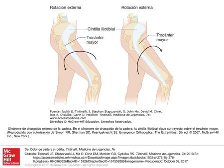Síndrome de chasquido externo de la cadera