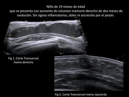 Niño de 19 meses de edad que se presenta con aumento de volumen mamario derecho de dos meses de evolución. Sin signos inflamatorios, dolor ni secreción.
