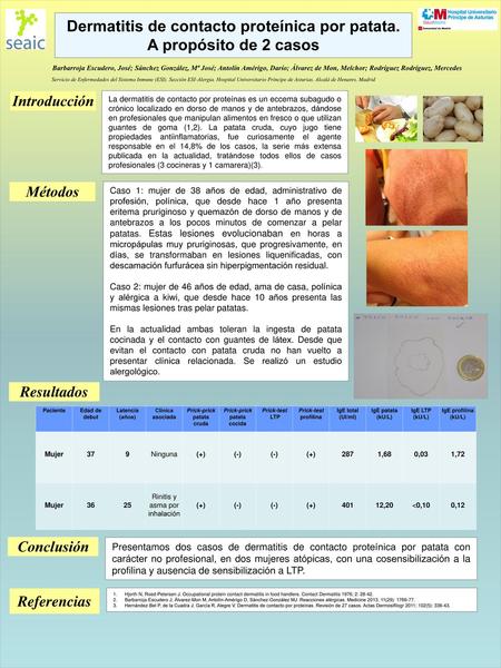 Dermatitis de contacto proteínica por patata. A propósito de 2 casos