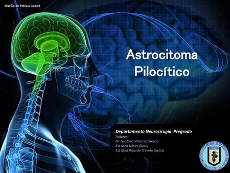 Astrocitoma Pilocítico