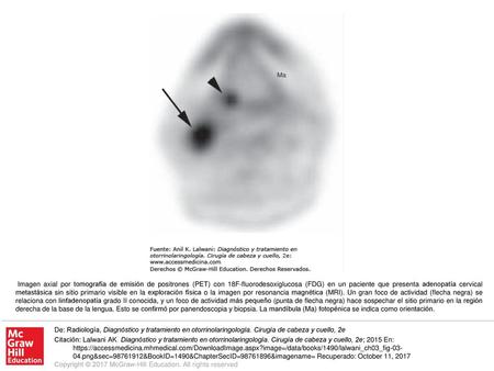 Imagen axial por tomografía de emisión de positrones (PET) con 18F-fluorodesoxiglucosa (FDG) en un paciente que presenta adenopatía cervical metastásica.