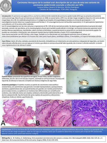 Carcinoma Verrugoso de la cavidad oral: descripción de un caso de esta rara variante de carcinoma epidermoide asociado a infección por HPV. Lorena Pefaur,