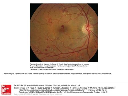 Hemorragias superficiales en flama, hemorragias puntiformes y microaneurismas en un paciente de retinopatía diabética no proliferativa. De: Empleo del.