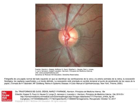 Fotografía de una papila normal del lado izquierdo en que se identifican las ramificaciones de la vena y la arteria centrales de la retina, la excavación.