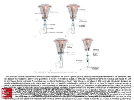 Colocación del sistema intrauterino de liberación de levonorgestrel