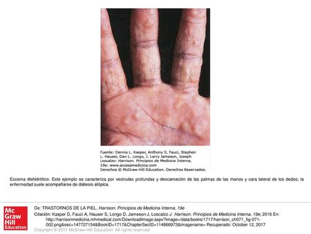 Eccema dishidrótico. Este ejemplo se caracteriza por vesículas profundas y descamación de las palmas de las manos y cara lateral de los dedos; la enfermedad.
