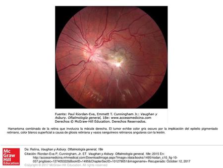 Hamartoma combinado de la retina que involucra la mácula derecha