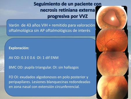Seguimiento de un paciente con necrosis retiniana externa
