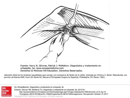 Liberación distal de los tendones isquiotibiales para corregir una contractura de flexión de la rodilla. (Ilustrada por Anthony C. Berlet. Reproducida,