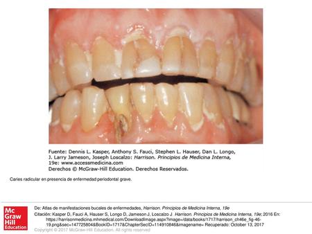 Caries radicular en presencia de enfermedad periodontal grave.