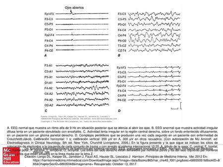 A. EEG normal que muestra un ritmo alfa de 9 Hz en situación posterior que se atenúa al abrir los ojos. B. EEG anormal que muestra actividad irregular.