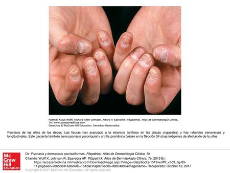 Psoriasis de las uñas de los dedos