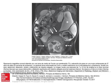 Resonancia magnética coronal obtenida con una toma de medio de Fourier con ponderación T2 y saturación de grasa en una mujer embarazada de 27 años de edad.