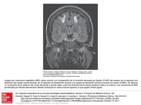 Imagen por resonancia magnética (MRI), plano coronal, con recuperación de la inversión atenuada por líquido (FLAIR) del cerebro de un paciente con alteración.