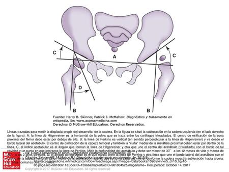 Lineas trazadas para medir la displasia propia del desarrollo, de la cadera. En la figura se situó la subluxación en la cadera izquierda (en el lado derecho.