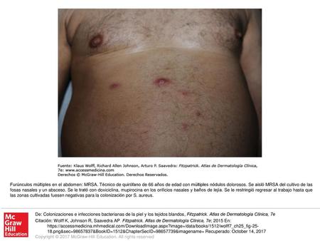 Furúnculos múltiples en el abdomen: MRSA