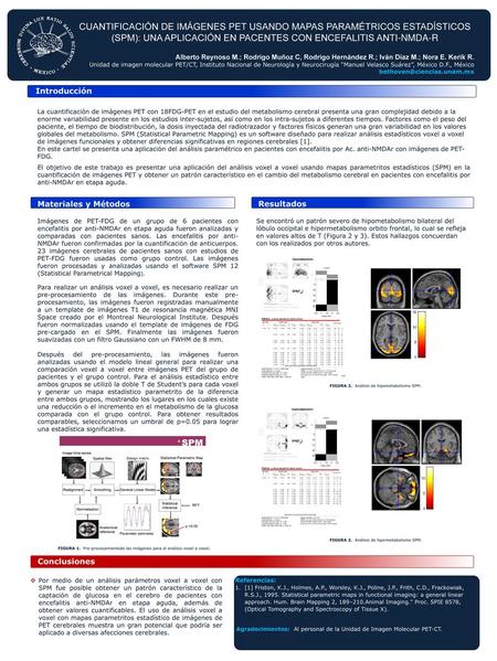 CUANTIFICACIÓN DE IMÁGENES PET USANDO MAPAS PARAMÉTRICOS ESTADÍSTICOS (SPM): UNA APLICACIÓN EN PACENTES CON ENCEFALITIS ANTI-NMDA-R Alberto Reynoso M.;