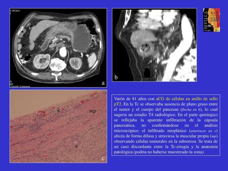 E b a Varón de 81 años con aCG de células en anillo de sello pT2. En la Tc se observaba ausencia de plano graso entre el tumor y el cuerpo del páncreas.
