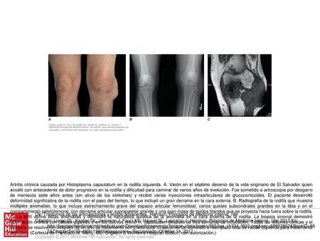 Artritis crónica causada por Histoplasma capsulatum en la rodilla izquierda. A. Varón en el séptimo decenio de la vida originario de El Salvador quien.