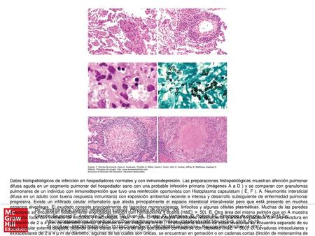 Datos histopatológicos de infección en hospedadores normales y con inmunodepresión. Las preparaciones histopatológicas muestran afección pulmonar difusa.
