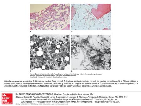 Médula ósea normal y aplásica. A, biopsia de médula ósea normal