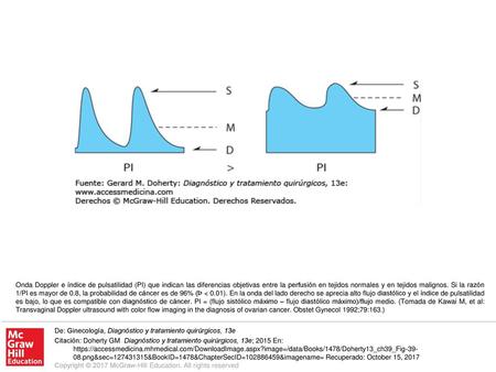 Onda Doppler e índice de pulsatilidad (PI) que indican las diferencias objetivas entre la perfusión en tejidos normales y en tejidos malignos. Si la razón.