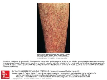 Escorbuto (deficiencia de vitamina C)