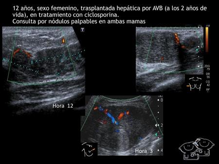12 años, sexo femenino, trasplantada hepática por AVB (a los 2 años de vida), en tratamiento con ciclosporina. Consulta por nódulos palpables en ambas.