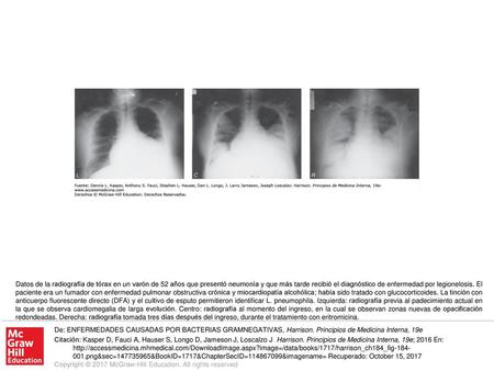 Datos de la radiografía de tórax en un varón de 52 años que presentó neumonía y que más tarde recibió el diagnóstico de enfermedad por legionelosis. El.