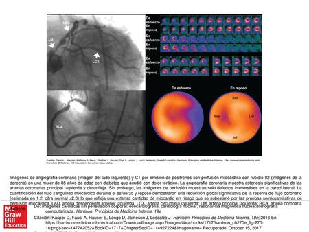 Imágenes de angiografía coronaria (imagen del lado izquierdo) y CT por emisión de positrones con perfusión miocárdica con rubidio-82 (imágenes de la derecha)