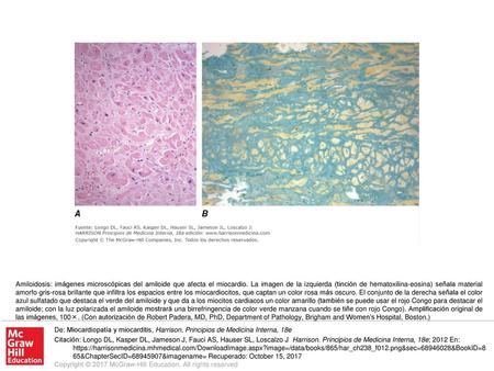 Amiloidosis: imágenes microscópicas del amiloide que afecta el miocardio. La imagen de la izquierda (tinción de hematoxilina-eosina) señala material amorfo.