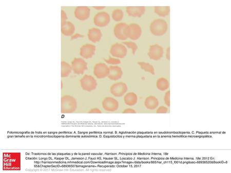 Fotomicrografía de frotis en sangre periférica: A
