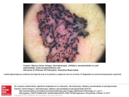 Lesión pigmentada con evidencia de hojas de arce en la periferia y ruedas de carro en el centro. El diagnóstico es carcinoma basocelular superficial. De: