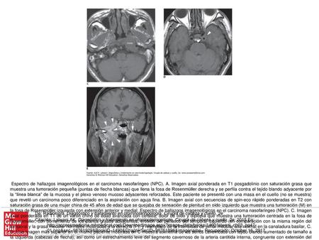 Espectro de hallazgos imagenológicos en el carcinoma nasofaríngeo (NPC). A. Imagen axial ponderada en T1 posgadolinio con saturación grasa que muestra.