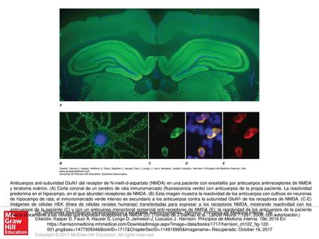 Anticuerpos anti-subunidad GluN1 del receptor de N-metil-d-aspartato (NMDA) en una paciente con encefalitis por anticuerpos antirreceptores de NMDA y teratoma.