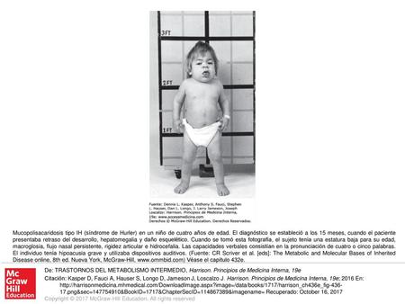 Mucopolisacaridosis tipo IH (síndrome de Hurler) en un niño de cuatro años de edad. El diagnóstico se estableció a los 15 meses, cuando el paciente presentaba.