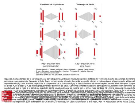 Izquierda. En la estenosis de la válvula pulmonar con tabique interventricular intacto, la expulsión sistólica del ventrículo derecho se prolonga de manera.