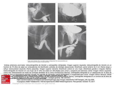 Uretras anteriores anormales: cistouretrografías de micción y uretrografías retrógradas. Imagen superior izquierda: cistouretrografía de micción en un.