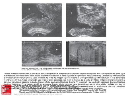 Uso de ecografía transrectal en la evaluación de la uretra prostática