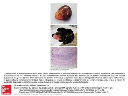Endometrioma. A. Pieza operatoria de un ovario con un endometrioma. B