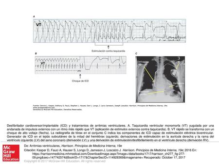 Desfibrilador cardioversor/implantable (ICD) y tratamientos de arritmias ventriculares. A. Taquicardia ventricular monomorfa (VT) yugulada por una andanada.