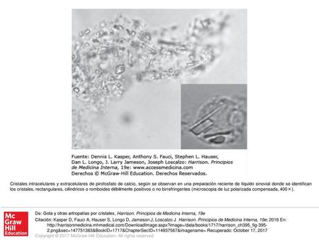 Cristales intracelulares y extracelulares de pirofosfato de calcio, según se observan en una preparación reciente de líquido sinovial donde se identifican.