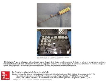 Cilindro típico (A) que se utiliza para la braquiterapia vaginal después de la cirugía por cáncer uterino. El cilindro se coloca en la vagina y se administra.
