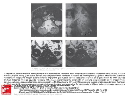 Comparación entre los métodos de imagenología en la evaluación de carcinoma renal. Imagen superior izquierda: tomografía computarizada (CT) que muestra.