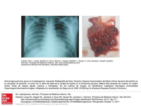 Hemorragia pulmonar grave en la leptospirosis