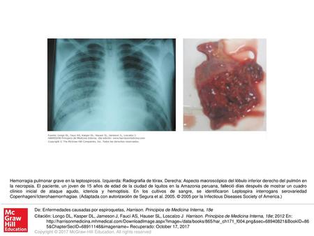 Hemorragia pulmonar grave en la leptospirosis