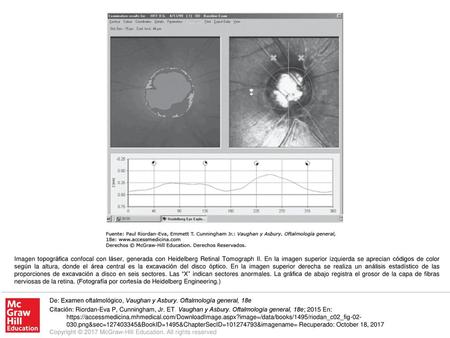 Imagen topográfica confocal con láser, generada con Heidelberg Retinal Tomograph II. En la imagen superior izquierda se aprecian códigos de color según.