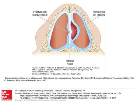 Esquema del hematoma en el tabique nasal