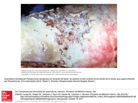 Quemadura infectada por Pseudomonas aeruginosa con licuación del tejido. Se advierte el color verdoso de los bordes de la herida, que sugiere infección.