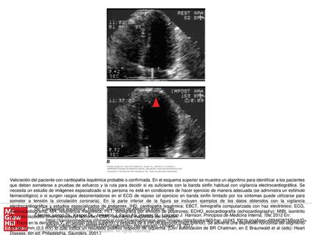 E. PET durante esfuerzo y reposo, de perfusión del miocardio, obtenidas con rubidio-82 en un sujeto con dolor retroesternal durante el esfuerzo. Las imágenes.